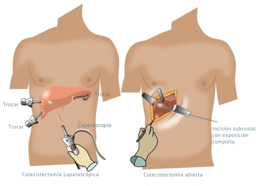 open vs laparoscopic cholecystectomy